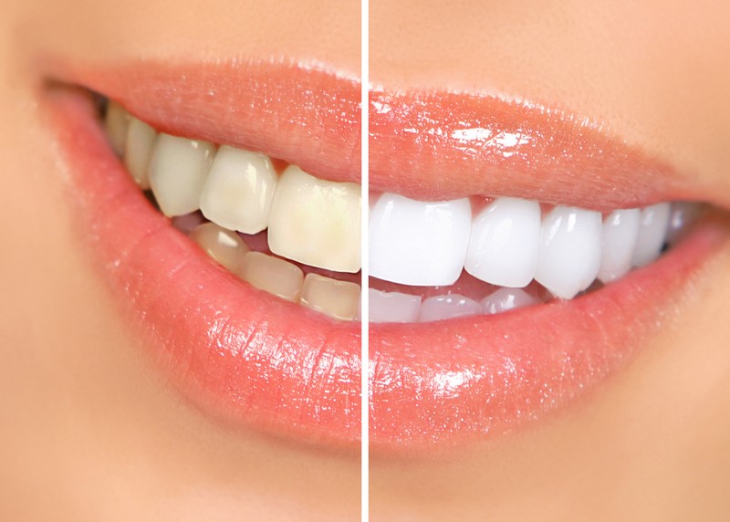 Teeth Whitening Huntington Woods, MI